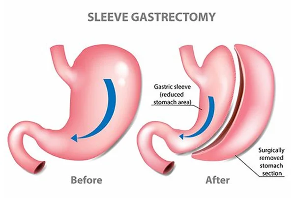 Sleeve Gastrectomy