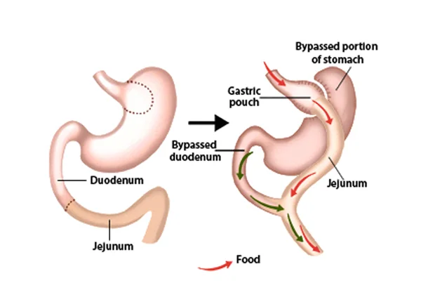 Bariatric Surgery