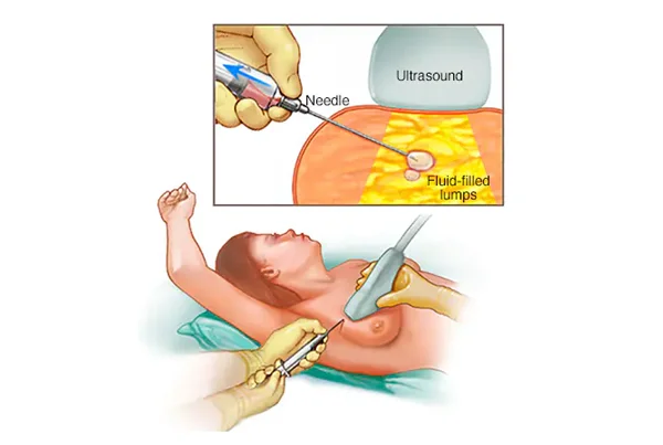 Benign Breast Lump Excision (Fibroadenomas)