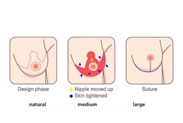 Breast Reduction Surgery