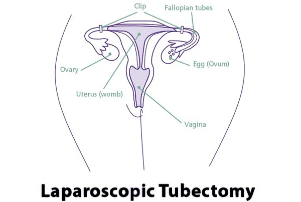 Laparoscopic Surgery