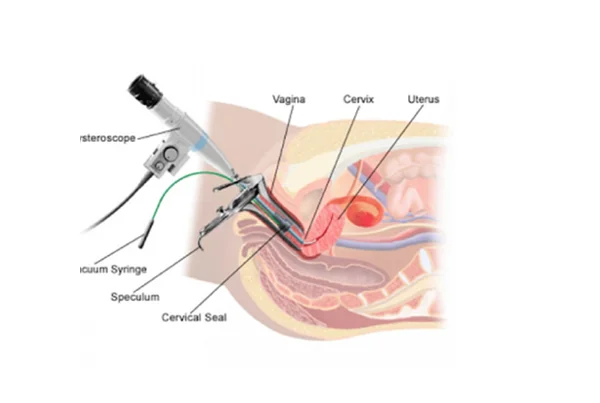 Total Laparoscopic Hysterectomy (TLH)