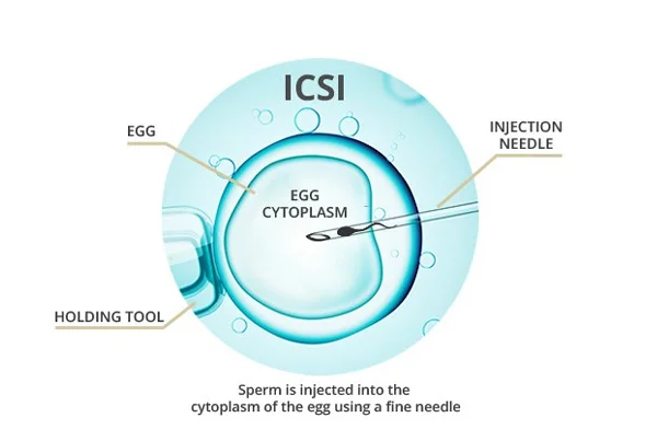 ICSI