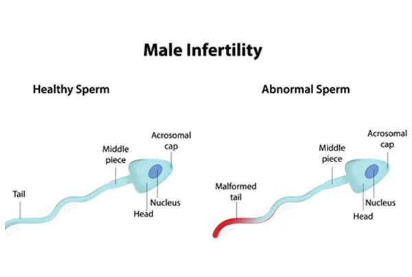 Male Infertility