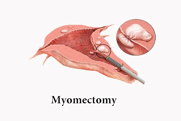 Myomectomy (Fibroid Surgery)