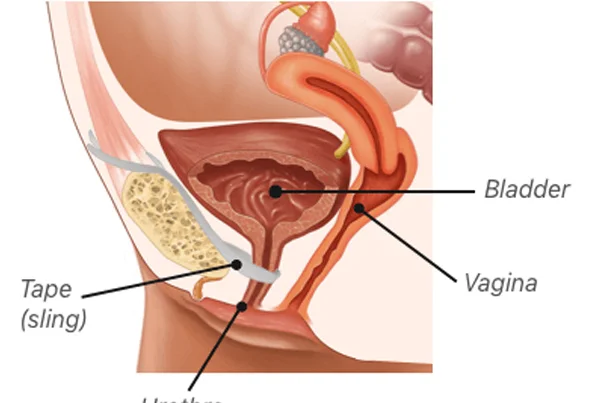 Sling Surgeries